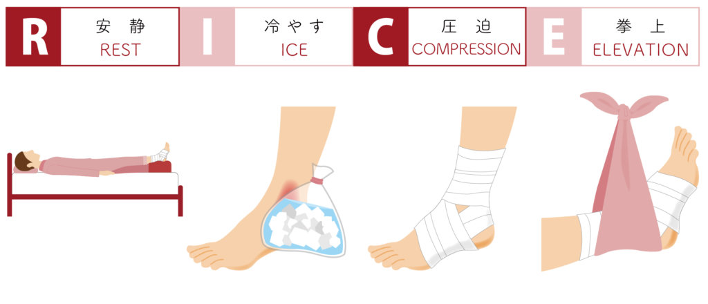 西船橋で捻挫 腱炎 腱鞘炎の応急処置と予防法 ジェッツ西船整骨院